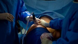 La lipoaspiration classique